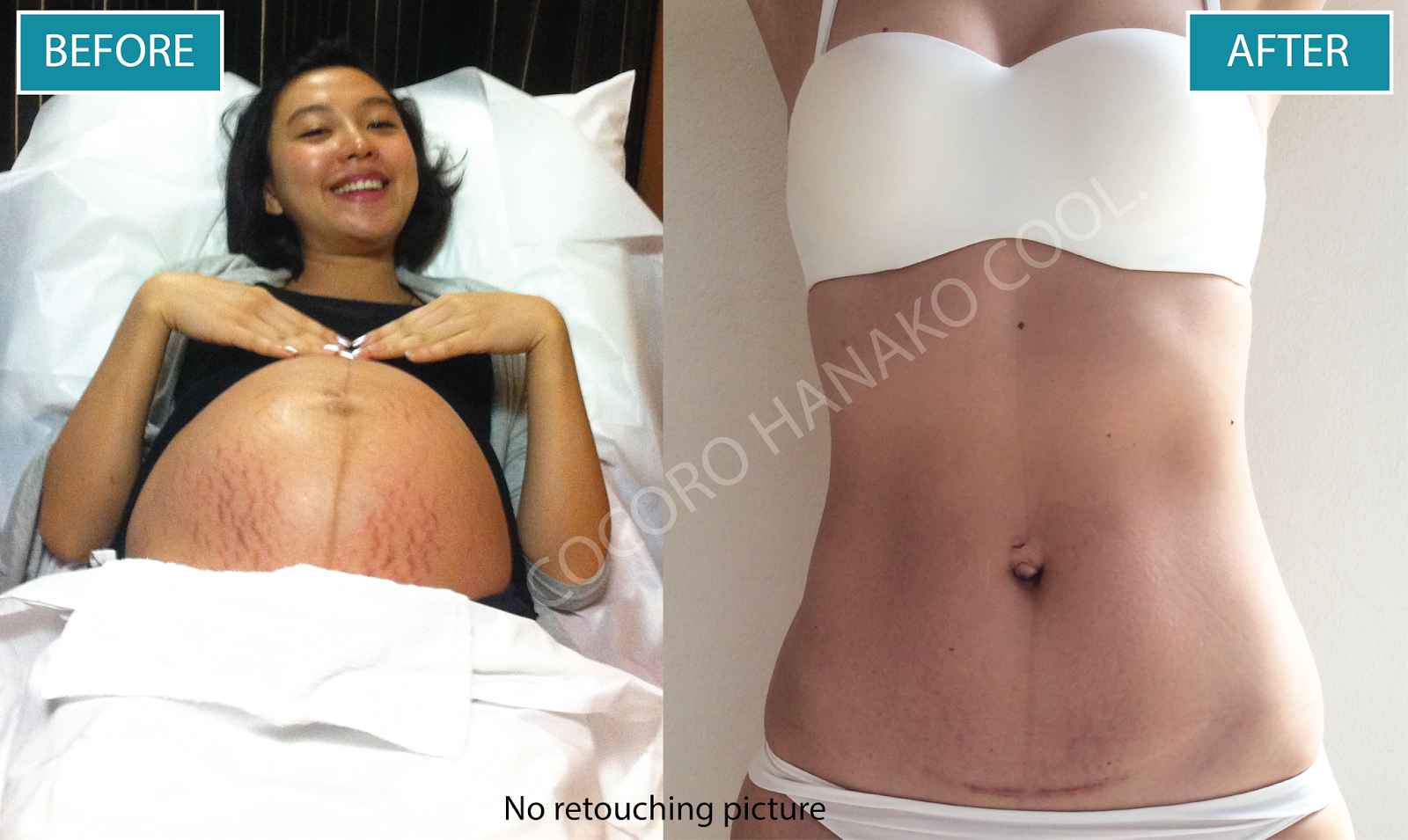 Cocoro Cool Anti Stretch Marks and Cellulite - Image 7