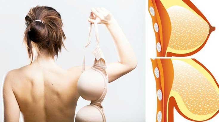 breast lift without surgery