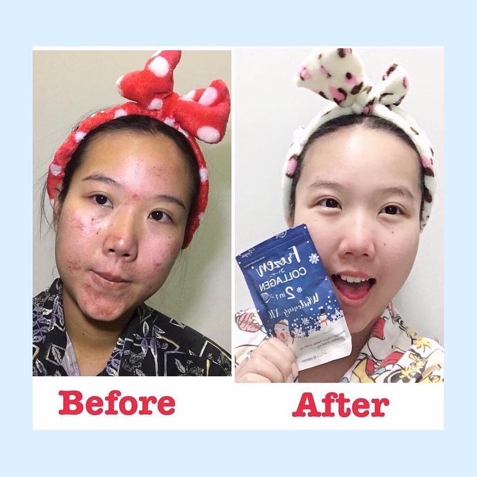 Frozen Collagen by Gluta Frozen - Image 9