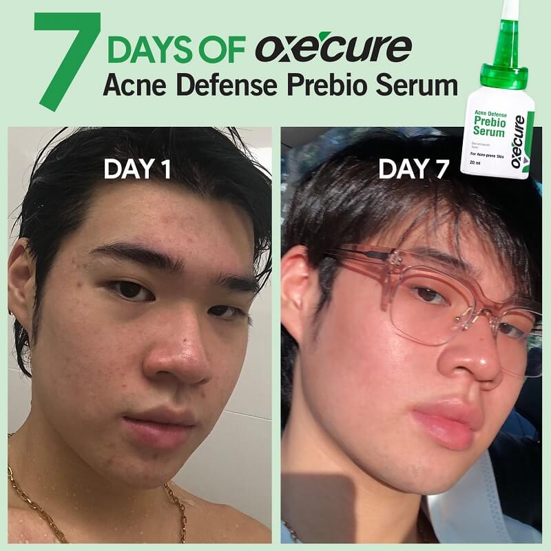OxeCure Acne Defense Prebio Serum - Image 7