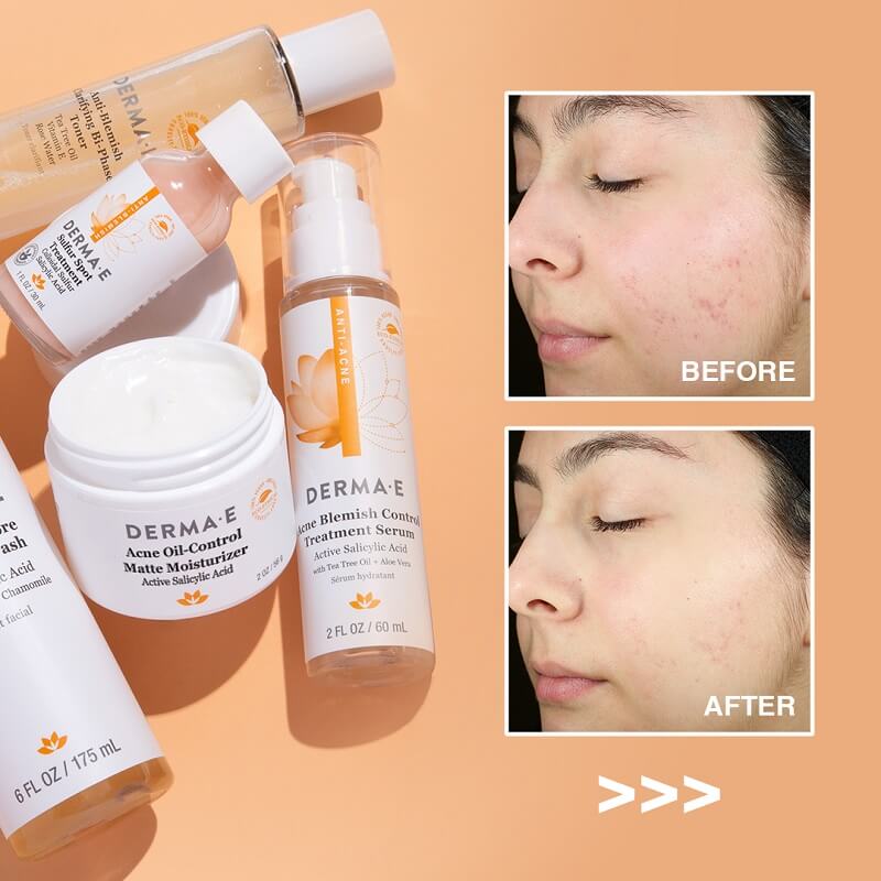 Derma E Acne Deep Pore Cleansing Wash - Image 7