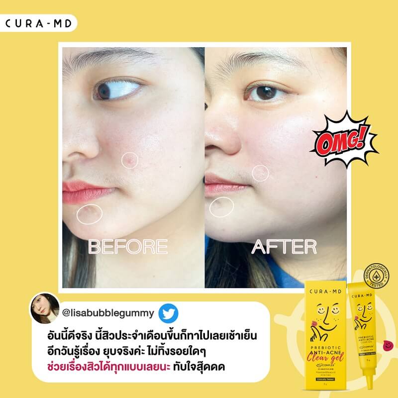 Cura-MD Prebiotic Anti-Acne Clear Gel - Image 7