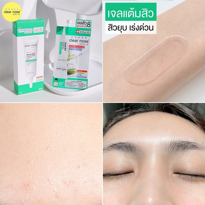 Clear Nose Acne Gel Concentrate Solution - Image 5