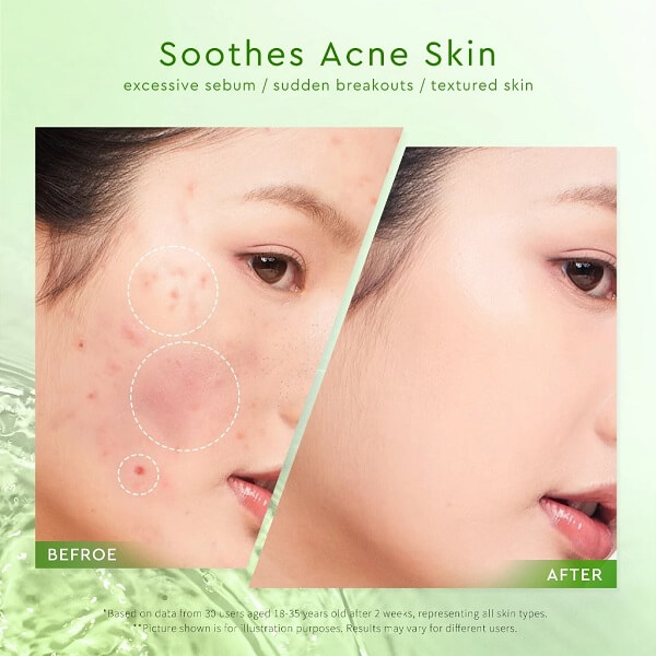Glad2Glow Mugwort Acne Gel Mask - Image 9